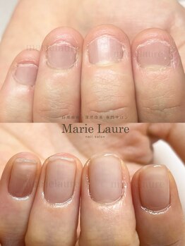 マリーロール 淀屋橋本店(Marie Laure)/自爪育成/深爪矯正/ネイルケア