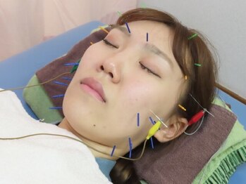 かえで接骨院 太平院の写真/【美容鍼×小顔矯正で究極の美小顔へ★】骨格とお肌の内部からしっかり引き上げ×電気鍼でリフトアップ！