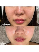 ラ フォルポ 恵比寿(La forepos)/エイジングケアハーブピーリング