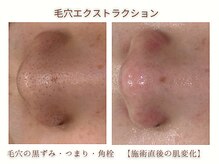 ミリ(MiLi)/つまり毛穴/黒ずみ毛穴/角栓