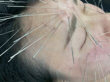 りんどう鍼灸院/ルート鬼美容鍼です