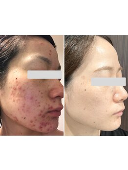 エミナル(EMINARU)/最強美肌へ!ニキビケア.肌質改善