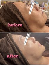 雅菜(miyabina)/フェイスライン美！顔つき変わる