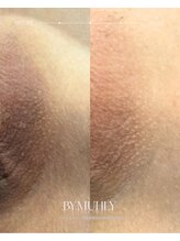 モア(more.)/Iラインの変化（1回）