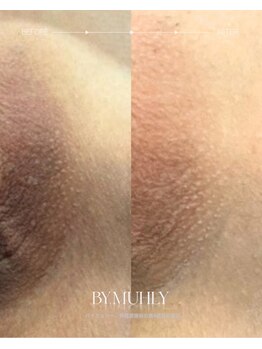 モア(more.)/Iラインの変化(1回)