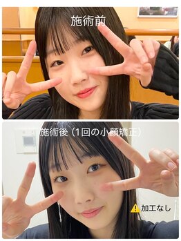 アリス(Alice)/小顔矯正 Before / After