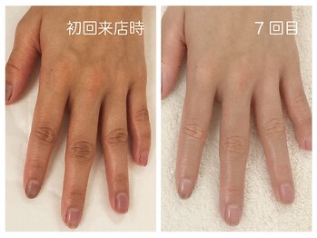 キレイテ 上野店/40代/7回目【東京ハンドケア】