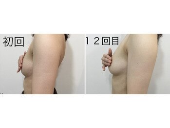 トータルビューティーサロン ナーズ(NAZ)/光バストアップ