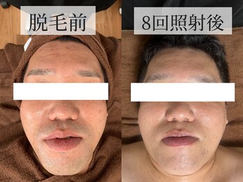 ベルフィーヌ 恵比寿店(BELFINE)/【幅広い年齢層】メンズ脱毛