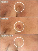 ハピネス(Hapiness)/シミケア☆結果に感動する方続出