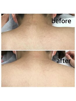 バルミー(Balmy)/ビフォーアフター脱毛の魔法