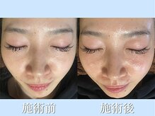 リブ(LIB)/毛穴洗浄ウォーターピーリング12