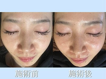 リブ(LIB)/毛穴洗浄ウォーターピーリング12