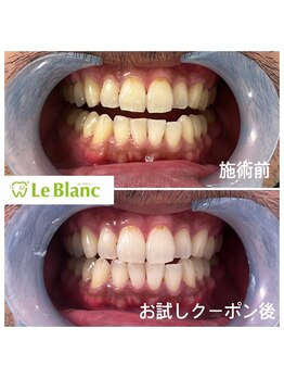 ルブラン 奈良店(Le Blanc)/憧れの白い歯に!