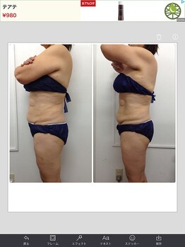 健康痩身研究所 蟹江店/ビフォーアフター