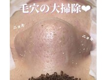 ミラーヴ(MERAVE)/毛穴が空っぽになる