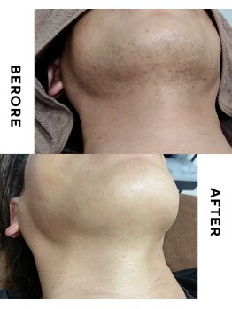 ルアナ(Luana)/メンズヒゲ脱毛~爆抜けモード~