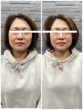 長寿鍼灸院 長寿整骨院/美容鍼25本の効果★リフトアップ