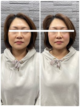 長寿鍼灸院 長寿整骨院/美容鍼25本の効果★リフトアップ