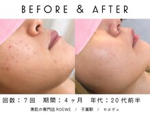 ロエヴェ(ROEWE)/ニキビ改善・毛穴ケア・肌質改善
