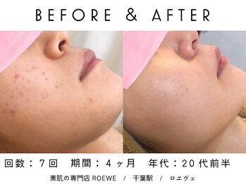 ロエヴェ(ROEWE)/ニキビ改善・毛穴ケア・肌質改善