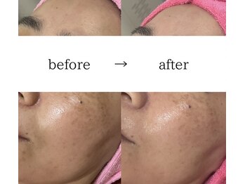 スパイリーア(Spiraea)/フェイシャルBeforeAfter