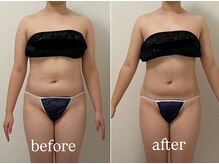 ラヴィアンローズ 忠節店(La vie en Rose)/ウルトラ筋膜 before→after