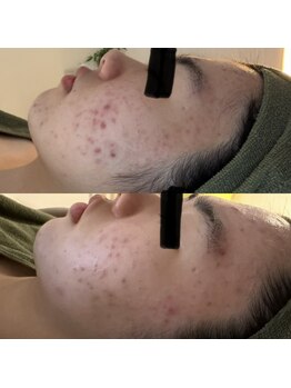 シーアイエステティック 船橋駅前店(c.iエステティック)/お顔のハーブピーリング♪