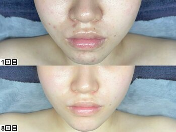 ハーブピーリング×韓国肌管理【&me福岡天神店】ピーリング/ララピール毛穴ニキビケア/ララピール【艶肌/肌質改善】