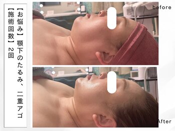 レッド(RED)/フェイスライン特化エステ