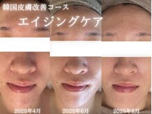 アールエーサロン 恵比寿 広尾(Ra salon)/LEDエイジングケア