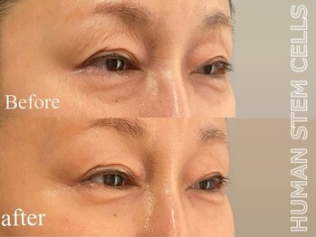 ココモンド(COCOMONDO)/幹細胞フェイシャル/エイジング