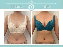 美人バスト 新潟店/ 【バストアップ★育乳】症例