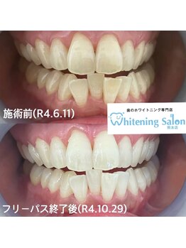 ホワイトニングサロン 熊本店/安いセルフホワイトニング