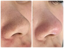 スナグル(Snuggle)/長年の毛穴悩み解消！