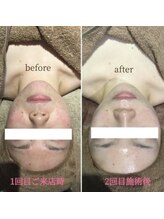 アンジュ(Ange)/陶器トリートメント