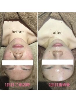 アンジュ(Ange)/陶器トリートメント