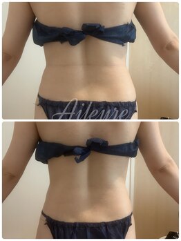 エルール トータルビューティ(Aileure total beauty)/インディバ痩身