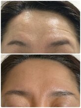 トリートメントルーム フェリーチェ(Felice)/額の深いシワに小顔筋膜リリース