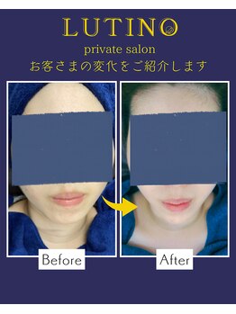 ルチノ(LUTINO)/小顔/二重あご/脂肪分解20代10回