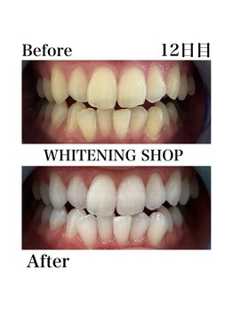 ホワイトニングショップ 西尾店/Before&After 12日目のお客様