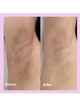 キワミビューティ(KIWAMI BEAUTY)/ローマピンク　脇　症例