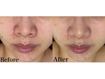 マーレン(Malen)/【クリスティーナ症例写真】