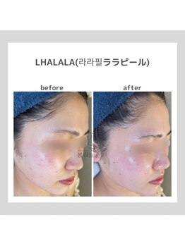 ポムハヌル 大阪梅田中崎町(pom.haneul)/韓国肌管理室