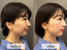 アルムボーテ 代官山 恵比寿(ARUIM Beaute)/シェービングビフォーアフター