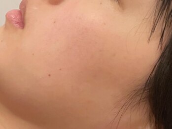 アクール(Accueil)の写真/ニキビ/背中ニキビ/ピーリング/毛穴ケアにお悩みの方は当店に一度お越しください★お悩みを解決します！