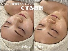 ソフ(soph.)/くすみ、美白症例