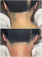 グロー(GLOW)/Wax脱毛