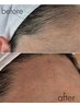 脱毛 (顔全体のムダ毛)