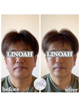 リノア 心斎橋店(LINOAH)/ウルトラプラス小顔リフト b→ a